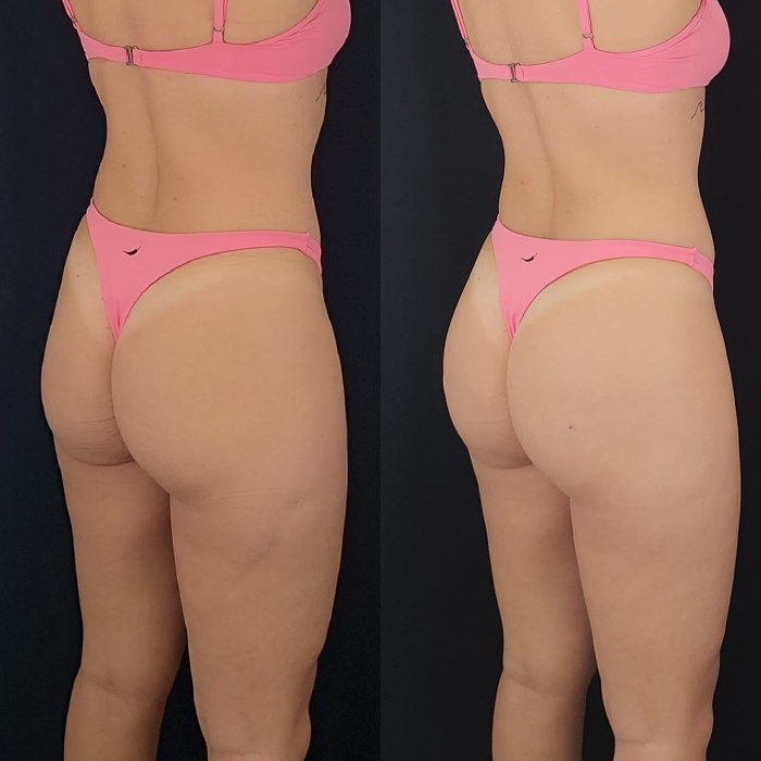 Bioplastia de gluteo antes e depois 1