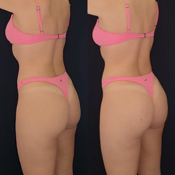 Bioplastia de gluteo antes e depois 113