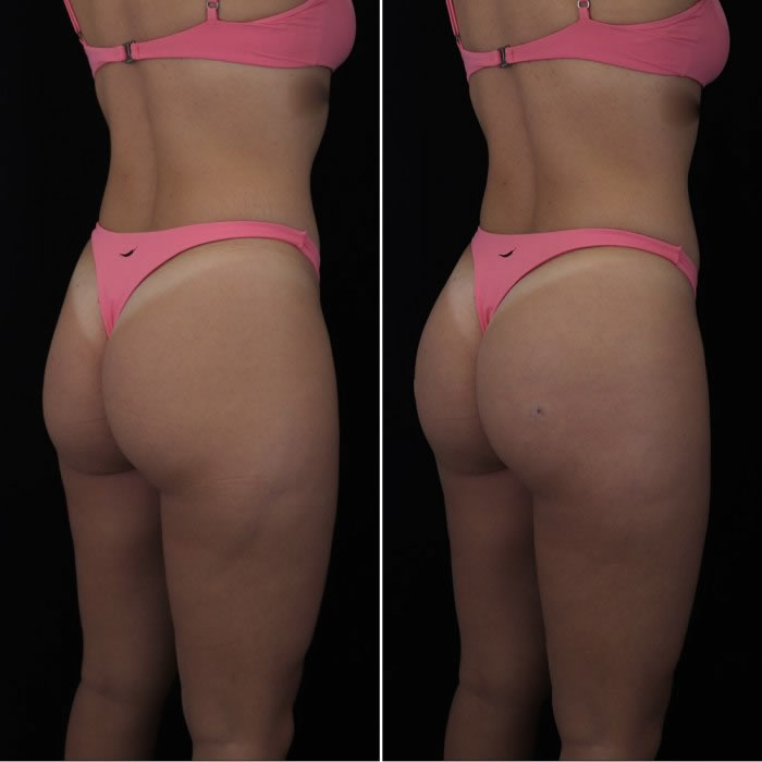 Bioplastia de gluteo antes e depois fotos 3